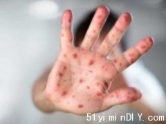 【皮尔区有孩童确诊麻疹】近日到过多处地方(图)
