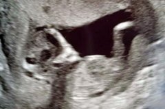 英孕妇做B超发现腹中胎儿形似外星人，担心被前