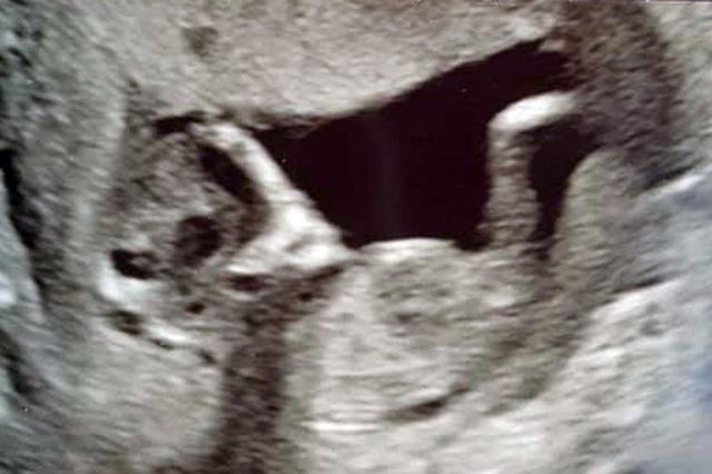 英孕妇做B超发现腹中胎儿形似外星人，担心被前任诅咒被吓坏了