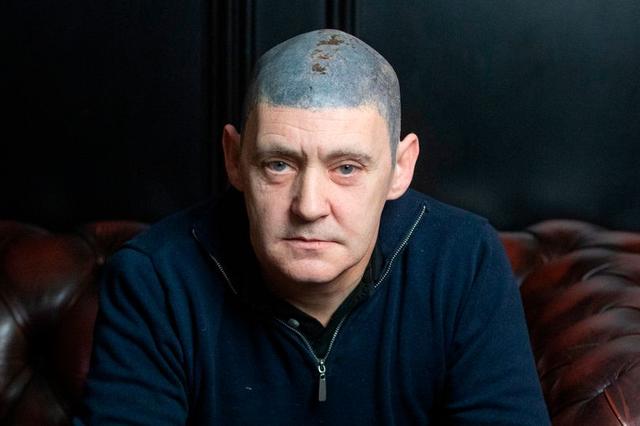 英国男子患癌接受化疗变光头抑郁自卑，无奈纹头发头皮发蓝成噩梦