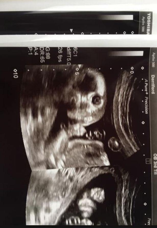 英国准妈妈怀孕20周做超声扫描，成型宝宝竟转过头面对镜头盯着她