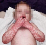 英国众多幼童爆发紫色皮疹，卫生部长：紧急研