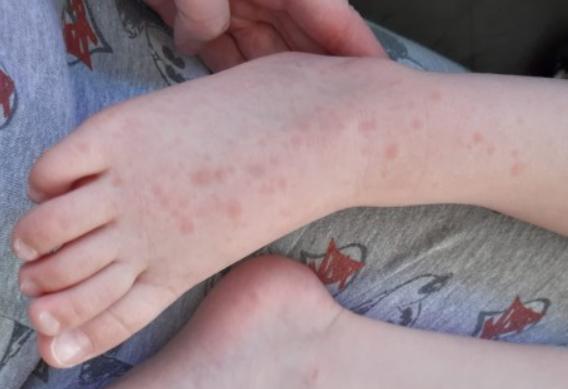 英国众多幼童爆发紫色皮疹，卫生部长：紧急研究是否为新冠新症状