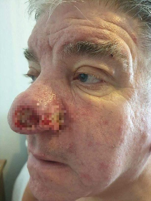 英爷爷鼻头出现流血小红点，谁料竟是癌还要切鼻子，留下畸形大洞