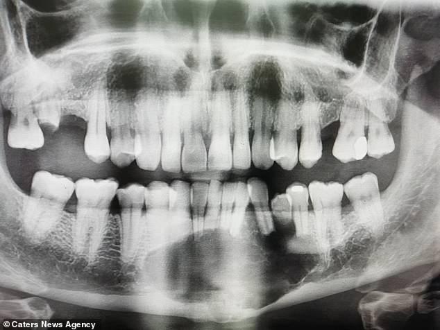 英男子恐惧看牙医，27年后终做检查：下巴长拳头大肿瘤被迫摘除