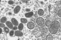 猴痘会成为全球大流行病吗？有10个问题您应该知道