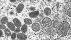 【猴痘】安省确诊1例  全国已确诊26宗猴痘病例(图)