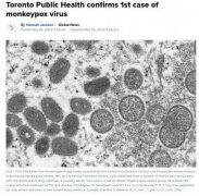 多伦多公共卫生部确认发现首例猴痘病毒病例