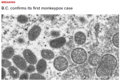 刚刚BC惊爆确诊首例猴痘 就在温哥华! 北美已人传人