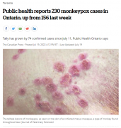 安省报告230例猴痘病例！男男行为为主要传播途径