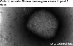 安省三天新增猴痘病例58，3/4的病例在多伦多!