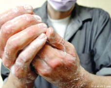 加国猴痘病例高达745宗 安省出现一名女患者！