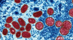 安省猴痘病例一周增15% 已有州区宣布紧急状态