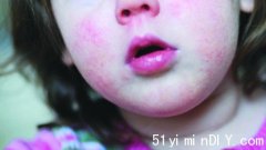 儿童感患现喉咙痛皮疹高烧 A组链球菌病例今年增超预期(图)