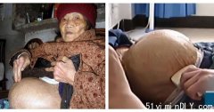 91岁阿婆跌倒发现怀孕！医检查惊:肚里有完整胎儿